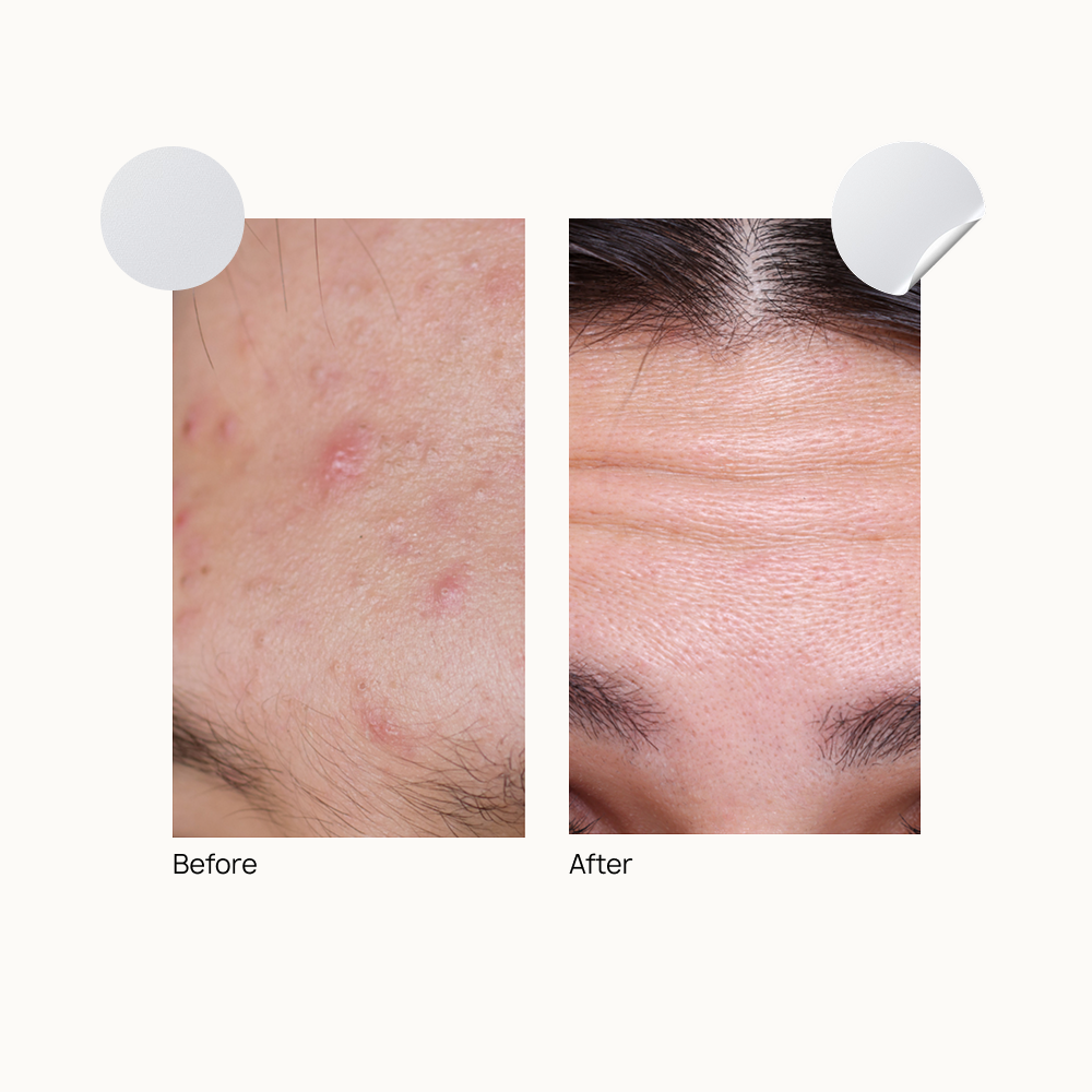 Forehead Acne Rescue Patch