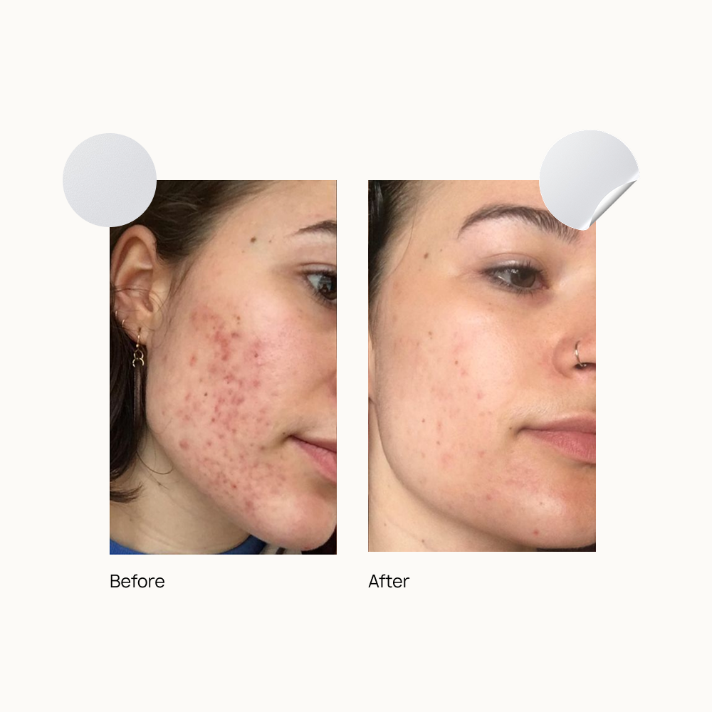 Acne Action Kit