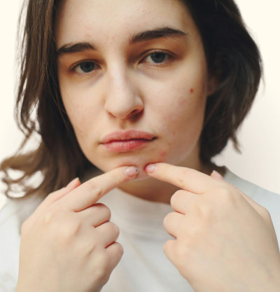 Hormonal Acne