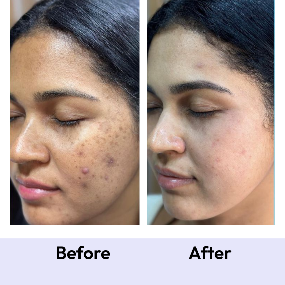 Mono Clarity+: Acne Detox Gummies