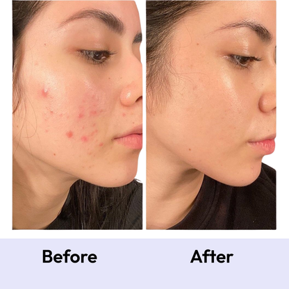 Mono Clear+ Inside: Acne Healing Pack