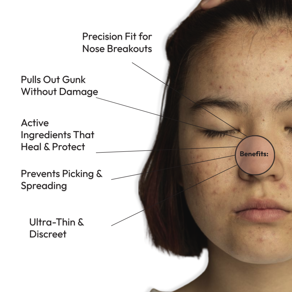 Mono Rescue Nose Acne Patch