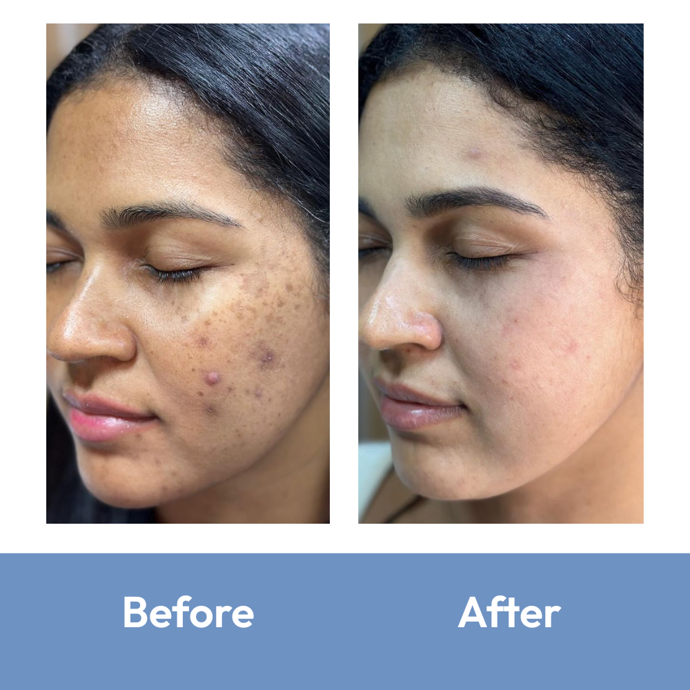 Mono Rescue Nose Acne Patch