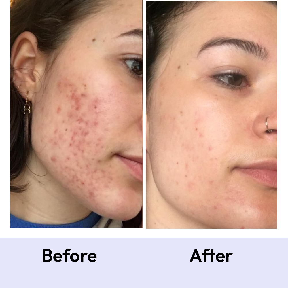 Acne Action Kit