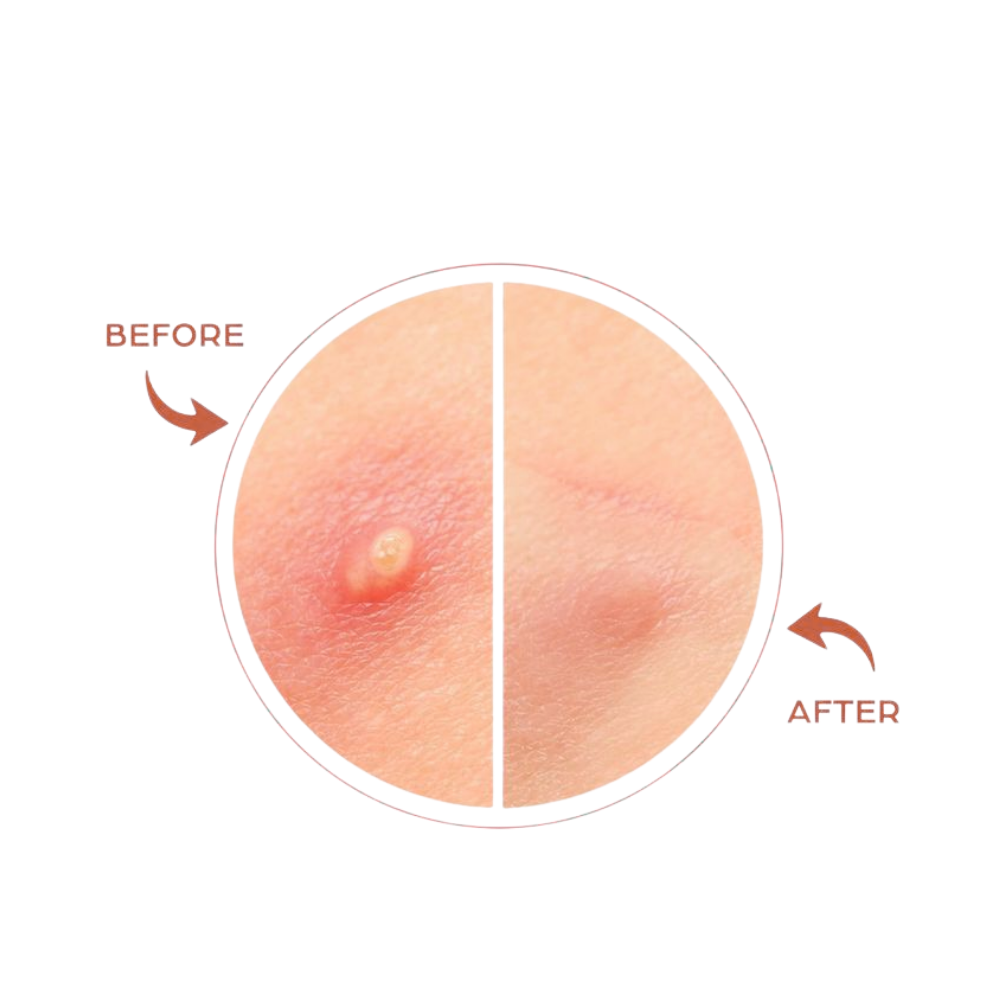 36 Dot Rescue Acne Patch