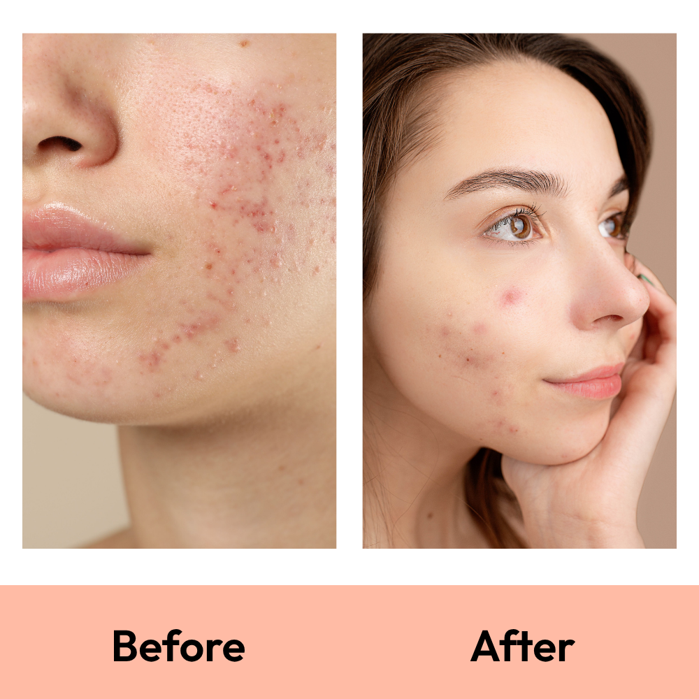 36 Dot Rescue Acne Patch
