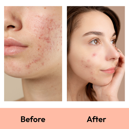 36 Dot Rescue Acne Patch