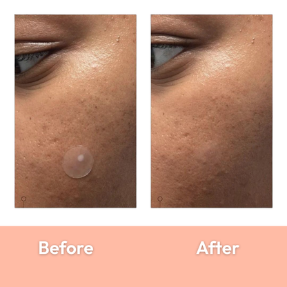 36 Dot Rescue Acne Patch