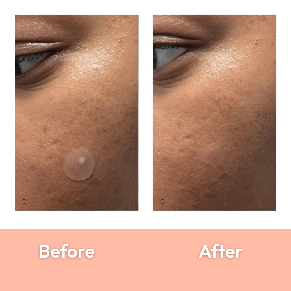 Mono Rescue+ Acne dot Patch 72