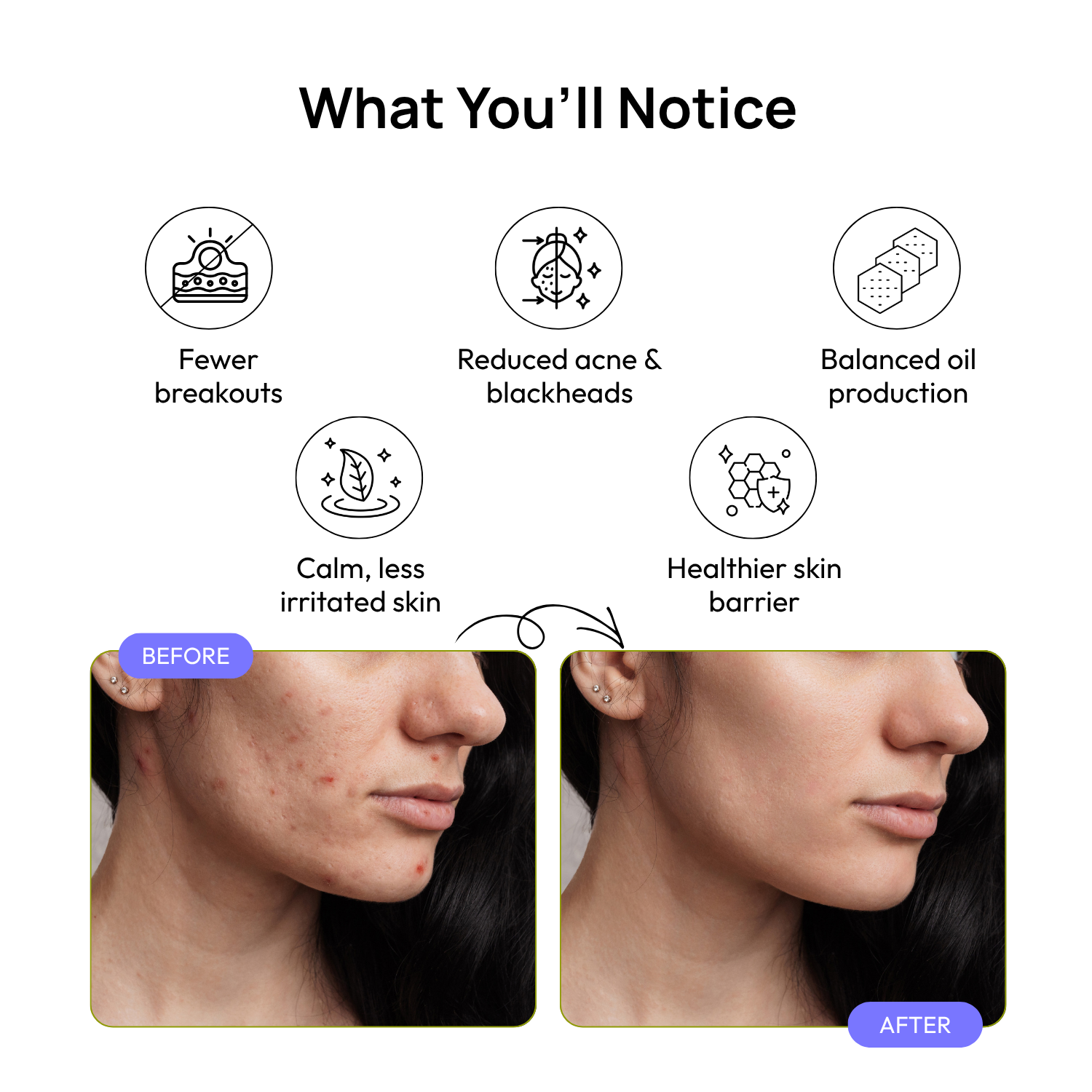 Acne Calm Serum