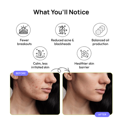 Acne Calm Serum