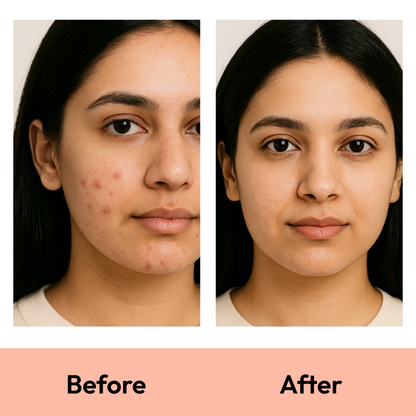 Mono Rescue: Acne Patch 36