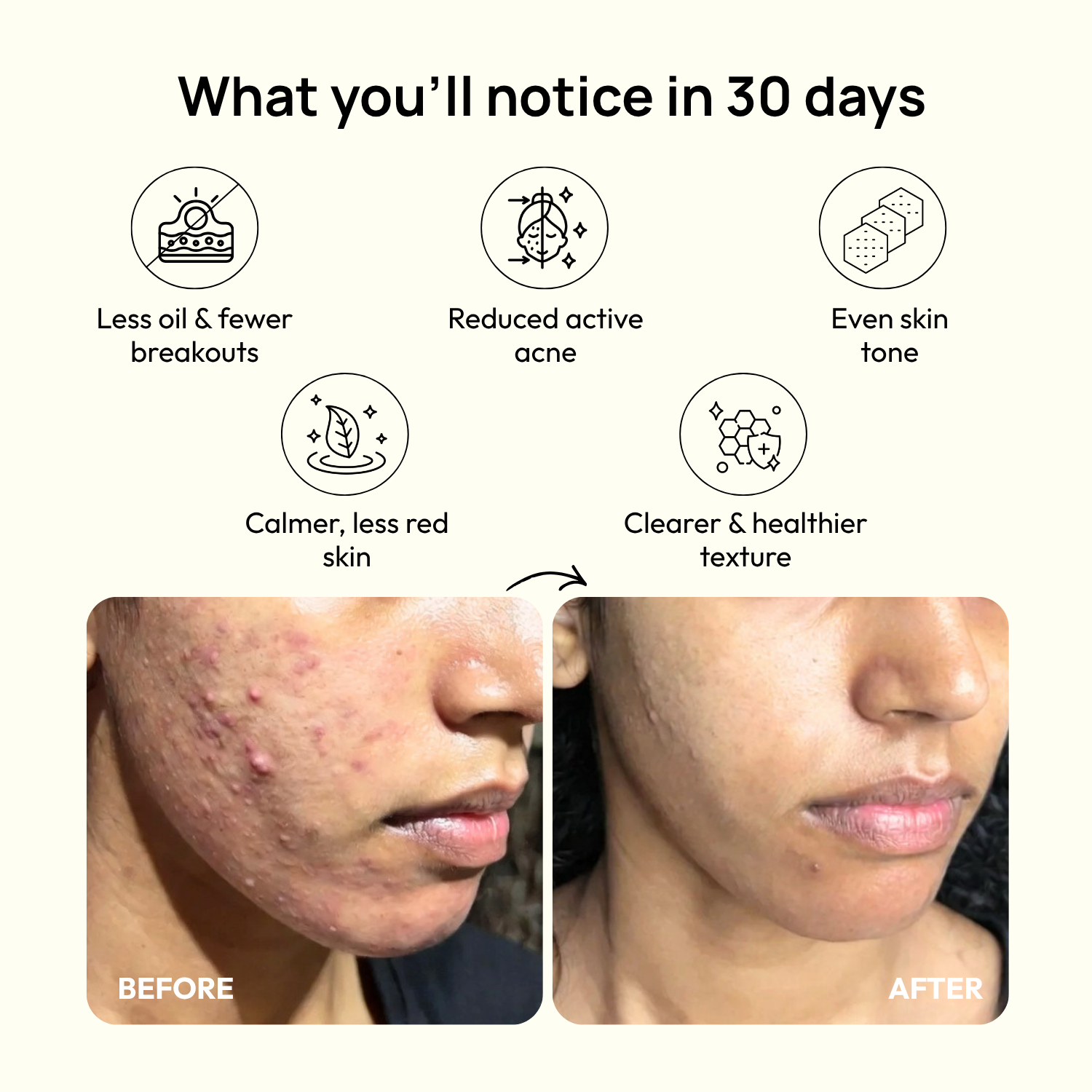 Stage 3 (Deep Inflammation): 90-Day Acne Recovery Plan