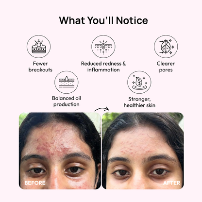 Stage 4 (POST-ACNE MARKS &amp; SCARS): 90-Day Acne Recovery Plan