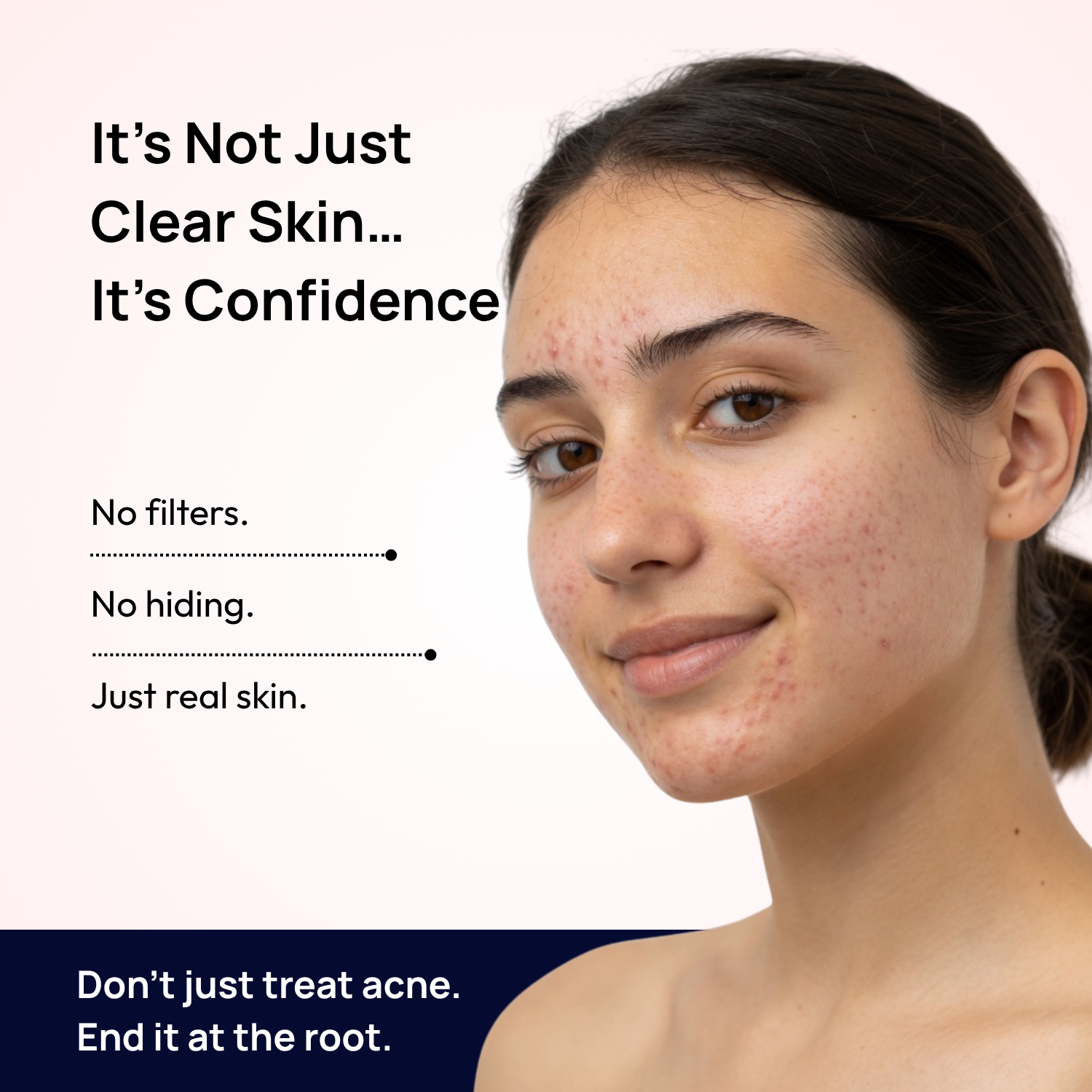 Stage 3 (Deep Inflammation): 90-Day Acne Recovery Plan