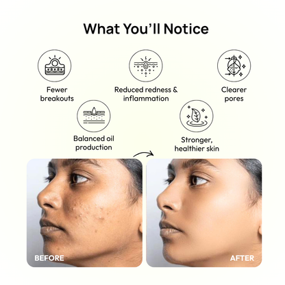 Stage 2 (Active Surface Breakout) : 90 Day Skin Transformation Plan