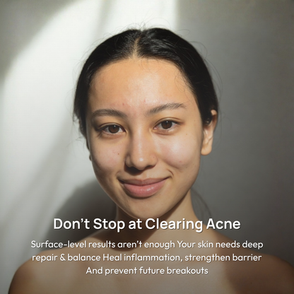 Stage 4 (POST-ACNE MARKS &amp; SCARS): 90-Day Acne Recovery Plan