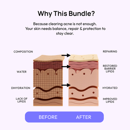 Stage 2 (Active Surface Breakout) : 90 Day Skin Transformation Plan