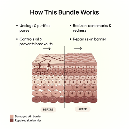 Stage 4 (POST-ACNE MARKS &amp; SCARS): 90-Day Acne Recovery Plan