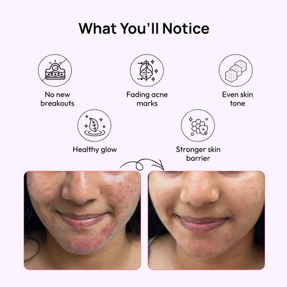 Stage 2 (Active Surface Breakout) : 90 Day Skin Transformation Plan