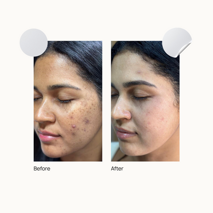 Pack Of 6  (1 Forhead 2 Nose 2 Chin + 36 dot patch)