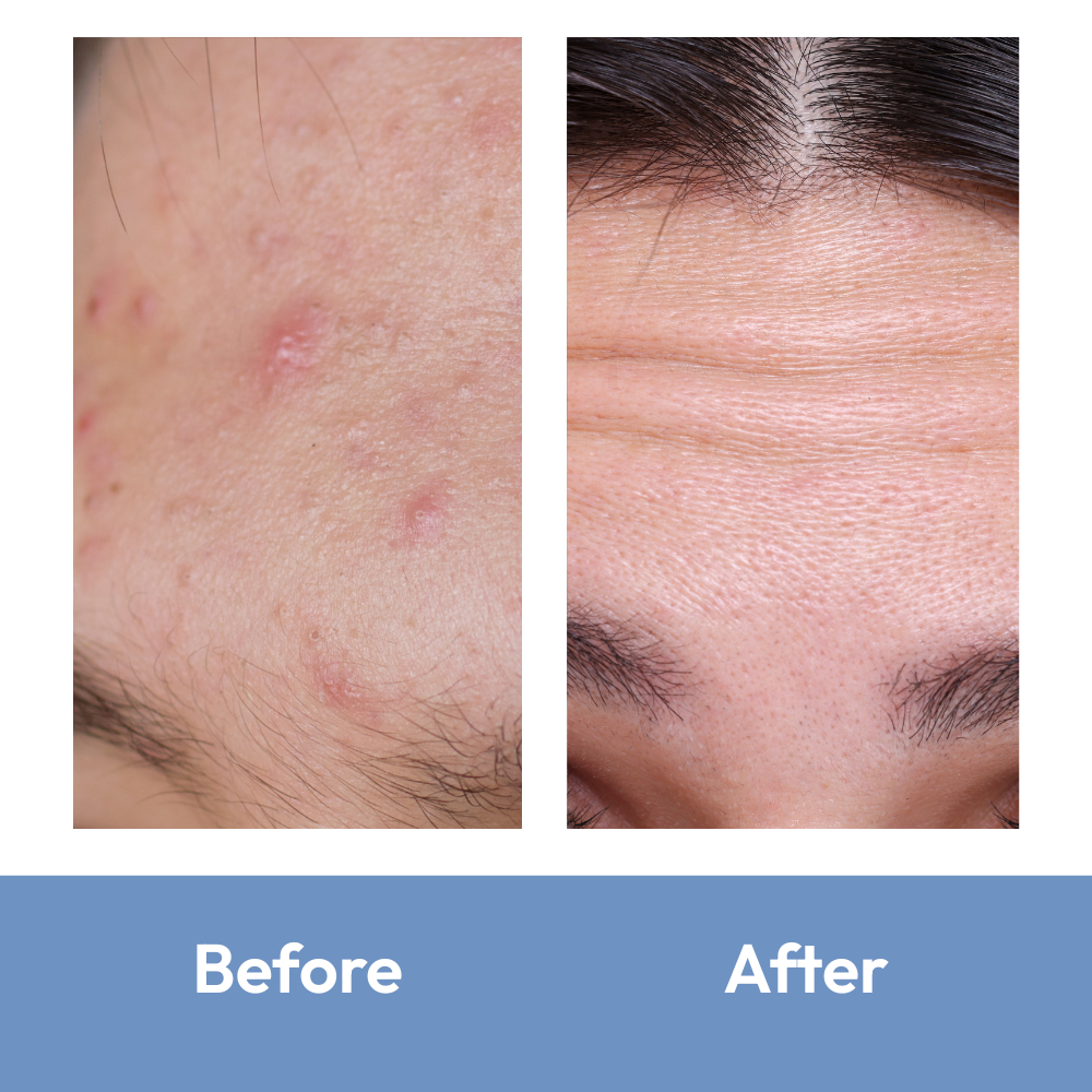 Rescue Forehead Patch